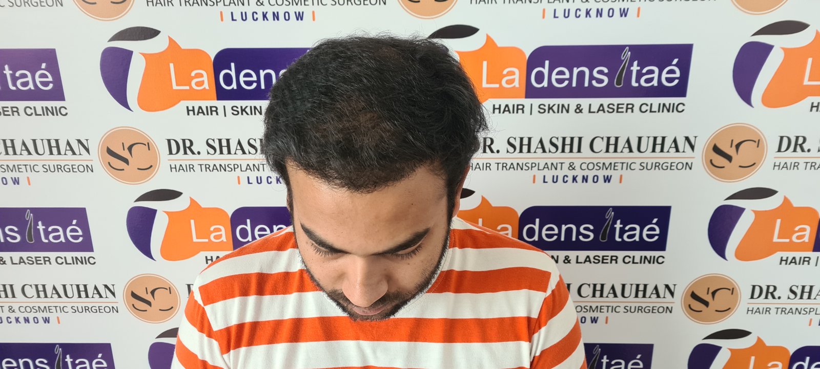 Arnav Dayal After Hair Transplant